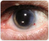 Many Medicare patients undergo unnecessary routine preoperative tests before cataract surgery