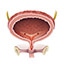 Bladder Cancer