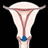 Cervical Cancer