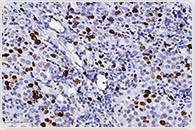 Assess Biospecimens for ADC Development with Ki67 Tissue Staining