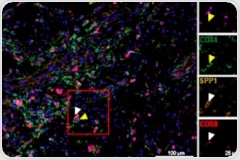 Integrative Multiomics Approach Unveils Systemic Dysfunction in Colorectal Cancer (CRC)