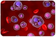 Supporting earlier diagnosis of multiple myeloma with serum free light chain assays