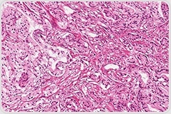 Training AI to Accurately Identify Biomarkers in Tumor Biospecimens