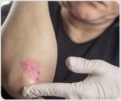 Study shows link between psoriasis severity and greater risk of type 2 diabetes