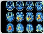 New brain mapping technique reveals link between connectivity and IQ