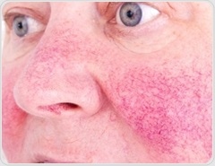 Rosacea and Small Intestinal Bacterial Overgrowth (SIBO)