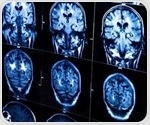 Epilepsy associated with volume and thickness differences in brain matter