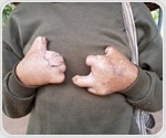 Genome analysis reveals leprosy's origin and drug resistance