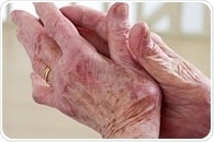 Women with rheumatoid arthritis suffer greater decline in physical function after menopause