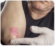 Researchers win $6.5 million NIH grant to personalize diagnosis and treatment of psoriasis