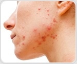 Patients with acne have increased risk of developing major depression