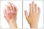 Researchers uncover new cause of dry, inflamed and itchy skin in eczema patients