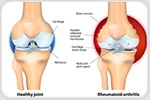 Researchers discover link between rheumatoid arthritis and bacteria in milk