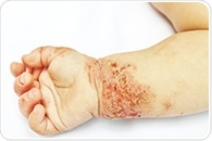 New suggests different approach to eczema treatment