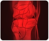 Weight loss after lap-band surgery alleviates arthritic knee pain