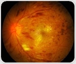Researchers find expression of lymphatic markers in proliferative diabetic retinopathy tissues