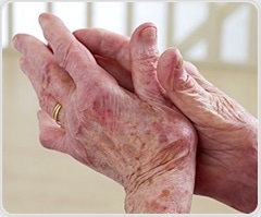 Northwestern scientists bring precision medicine to rheumatoid arthritis