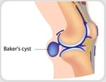 What is a Baker's Cyst?