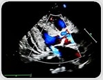 What is Mitral Regurgitation?