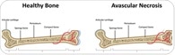 Avascular Necrosis (Osteonecrosis)