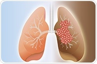 Study challenges use of whole-brain radiation for small-cell lung cancer patients with brain metastases