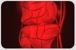 Weight loss after lap-band surgery alleviates arthritic knee pain