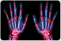 Environmental pollutants found to worsen rheumatoid arthritis