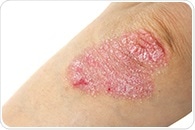 Clinical trial tests natural treatment to provide long-term solution for chronic eczema