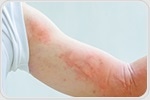 Poison ivy and poison oak can cause mild to severe allergic reactions