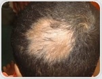 What is Folliculitis Decalvans (FD)