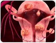 Uterine Artery Embolization: Technique and Complications