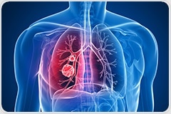 Low Blood Levels of Vitamin D Linked to Increased Risk of Interstitial Lung Disease