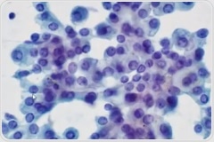 Acinic Cell Carcinoma