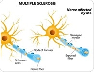 Anti-Myelin Antibodies in Multiple Sclerosis