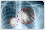 Inhibition of NOVA1 gene helps prevent growth of lung cancer tumors