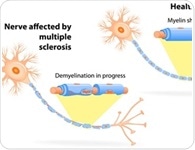 Optic Neuritis and Multiple Sclerosis