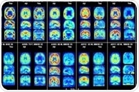 Researchers identify potential diagnostic tool for Alzheimer’s disease