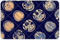 Episodic memory tests help in predicting brain atrophy and Alzheimer’s disease