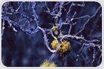 Novel therapeutic targets based on biology of aging show promise for Alzheimer's disease