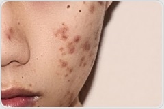 Acne could have a genetic basis find researchers promising new cure