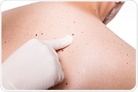 Cancer patients have greater risk of developing shingles, study shows