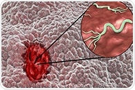 Investigational topical cream may be effective for treating atopic dermatitis