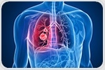 Graphene could hold key to unlock next generation of early lung cancer diagnosis