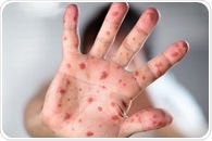 Misinformation is causing measles cases to rise worldwide