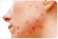 Acne relapses associated with impaired quality of life, productivity loss and absenteeism