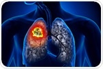 Deep-learning model better predicts survival outcomes for lung cancer