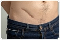 Appendix removal linked to increased risk of Parkinson's disease