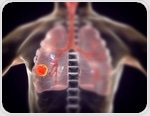 Lung cancer screening using Google AI proves to be successful