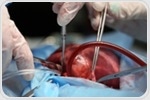 Flash fire in patient's chest cavity during emergency heart surgery