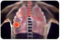 Lung cancer screening using Google AI proves to be successful
